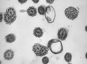 M,12y. | immotile cilia syndrome - nasal mucosa M,12y. | immotile cilia syndrome - nasal mucosa